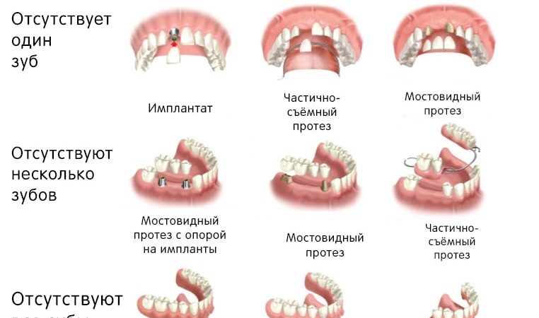 Виды зубных протезов, классификация и цена