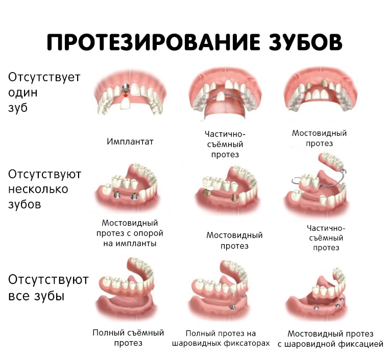 Виды зубных протезов, классификация и цена